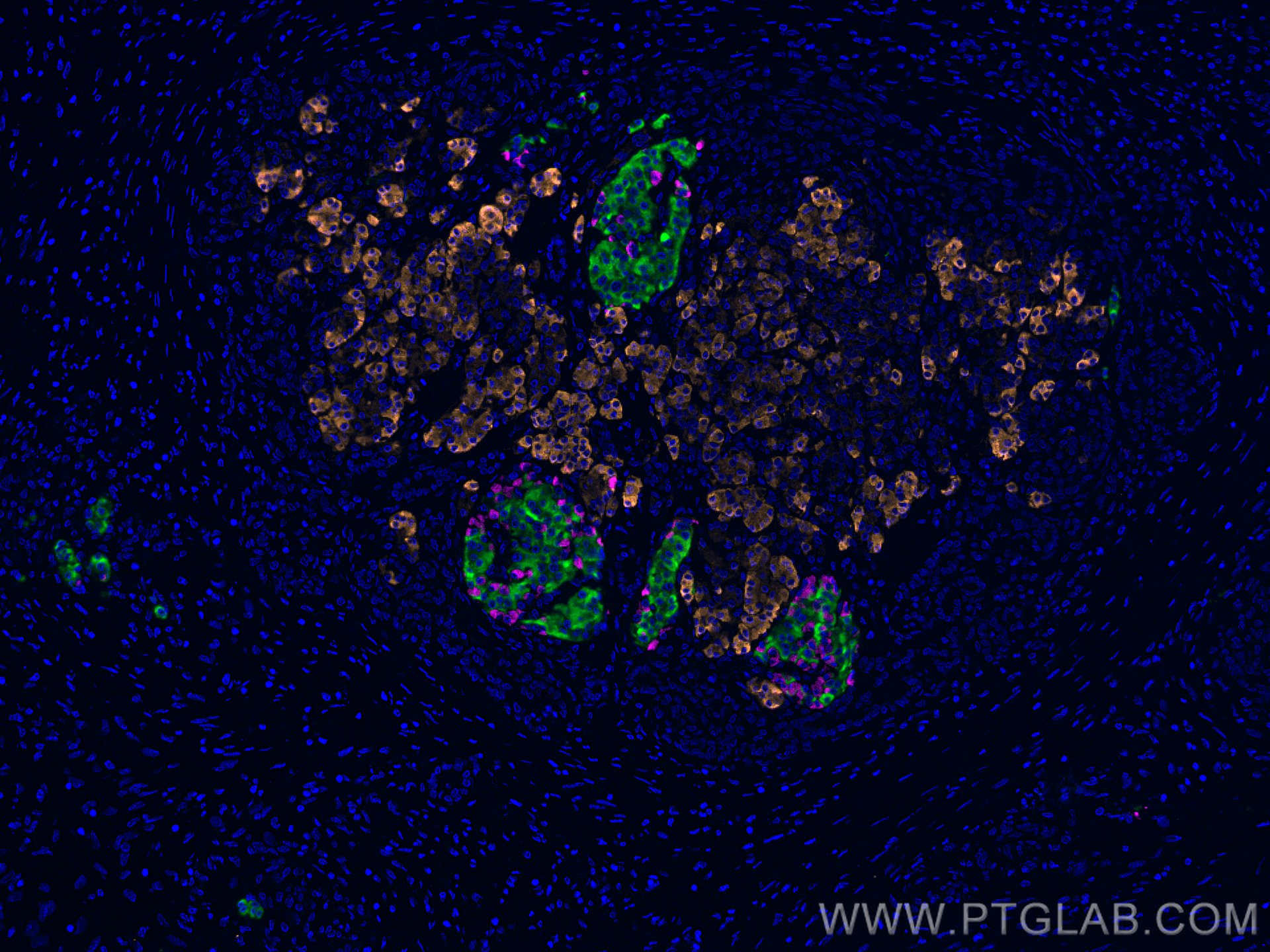 IF Staining of human pancreas cancer using 15384-1-AP