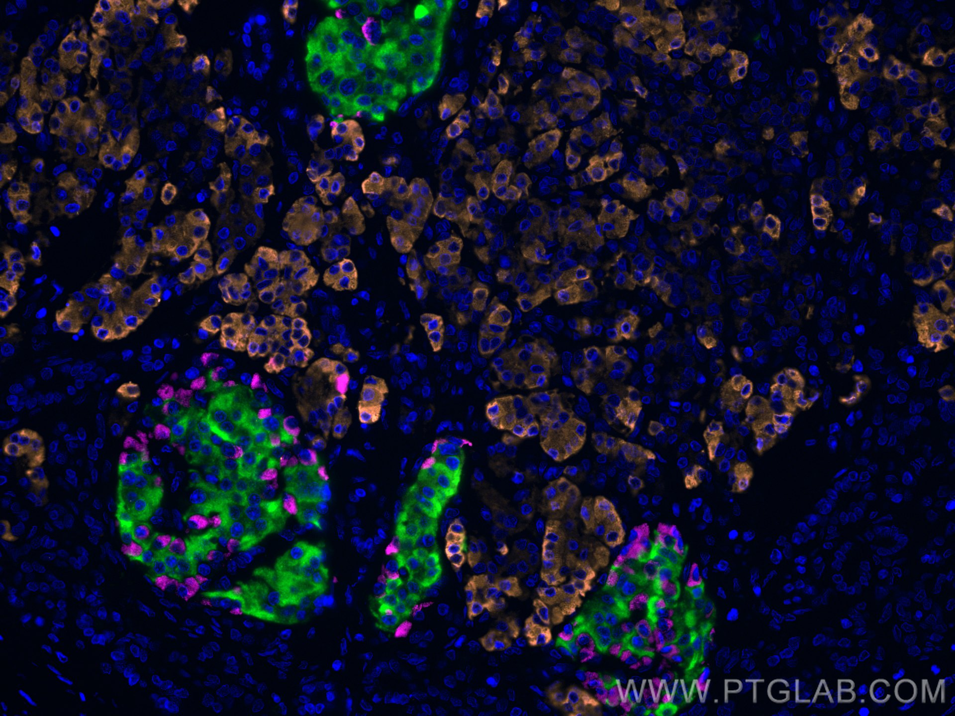 IF Staining of human pancreas cancer using 15384-1-AP