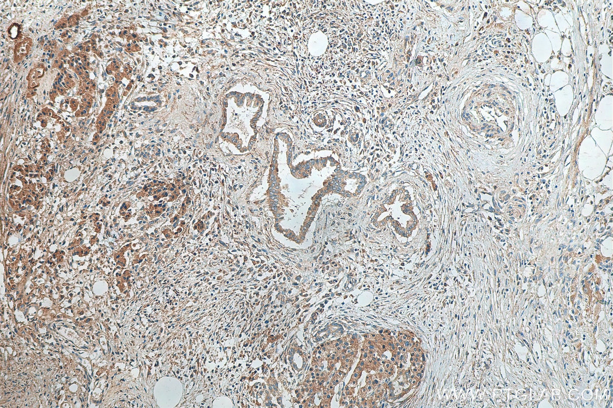 Immunohistochemistry (IHC) staining of human pancreas cancer tissue using CEL Polyclonal antibody (15384-1-AP)