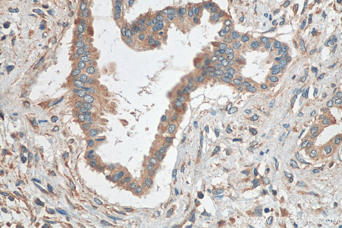 Immunohistochemistry (IHC) staining of human pancreas cancer tissue using CEL Polyclonal antibody (15384-1-AP)