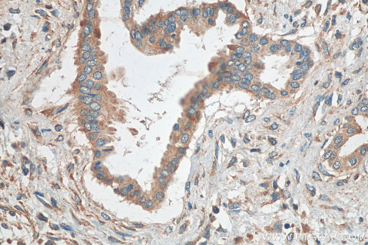 IHC staining of human pancreas cancer using 15384-1-AP