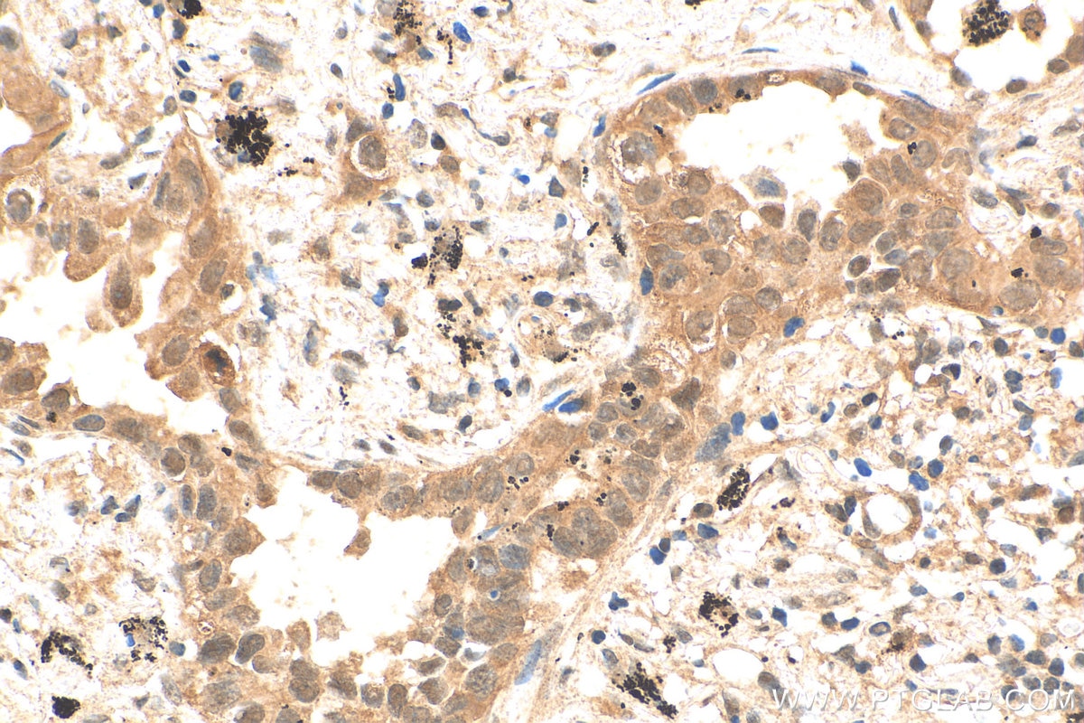 Immunohistochemistry (IHC) staining of human lung cancer tissue using CENPF Polyclonal antibody (28568-1-AP)