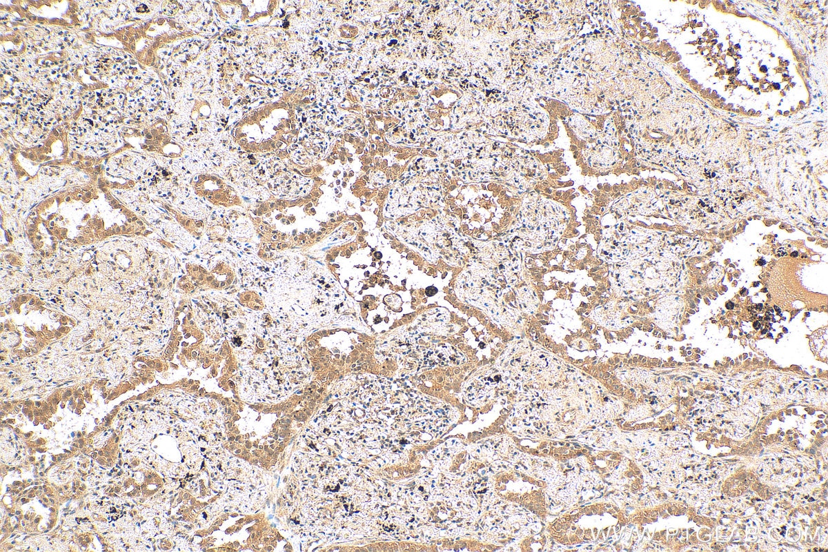 Immunohistochemistry (IHC) staining of human lung cancer tissue using CENPF Polyclonal antibody (28568-1-AP)