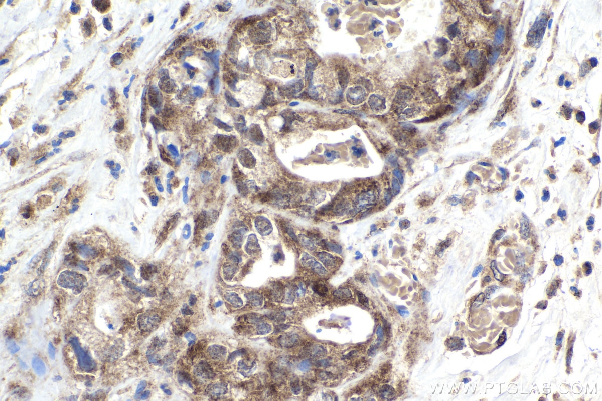 Immunohistochemistry (IHC) staining of human pancreas cancer tissue using CENPF Polyclonal antibody (28568-1-AP)