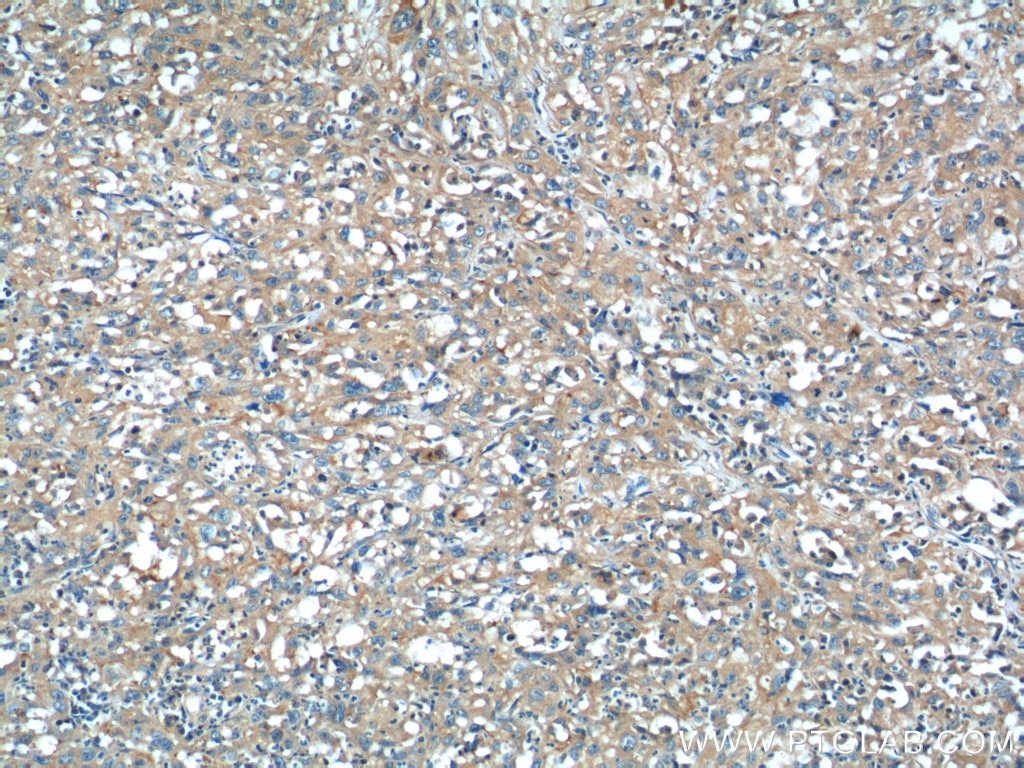 IHC staining of human cervical cancer using 22227-1-AP