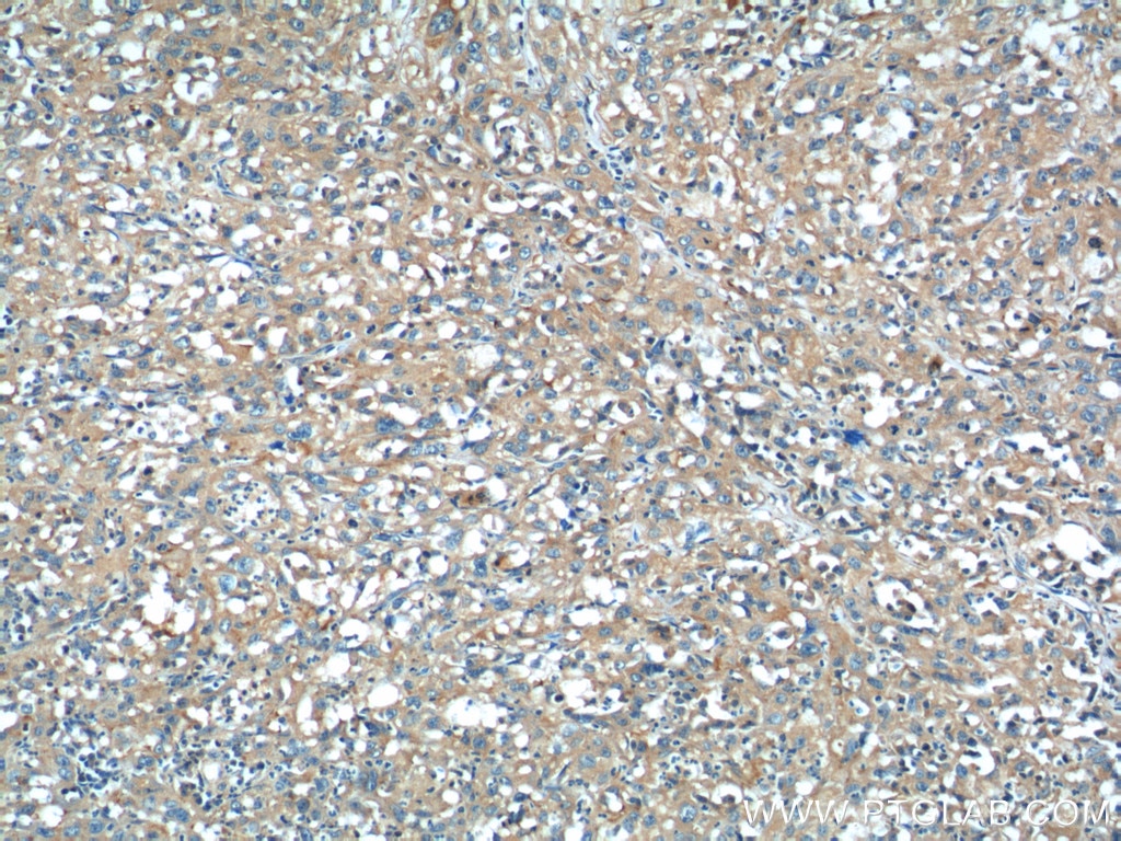 Immunohistochemistry (IHC) staining of human cervical cancer tissue using CEP164 Polyclonal antibody (22227-1-AP)