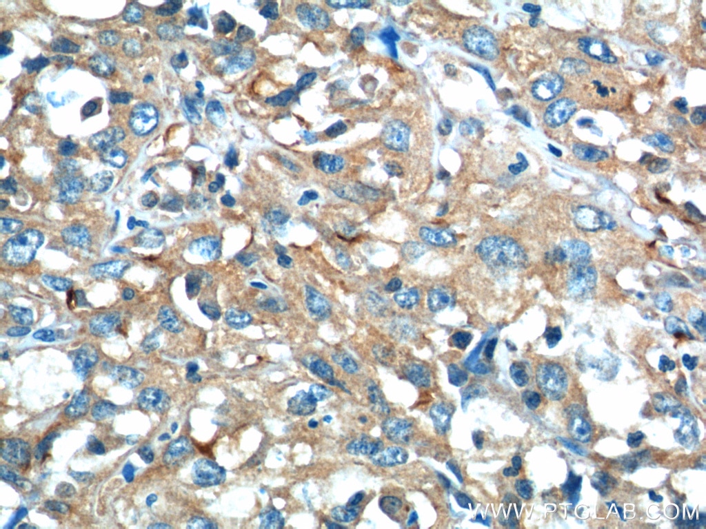 Immunohistochemistry (IHC) staining of human cervical cancer tissue using CEP164 Polyclonal antibody (22227-1-AP)