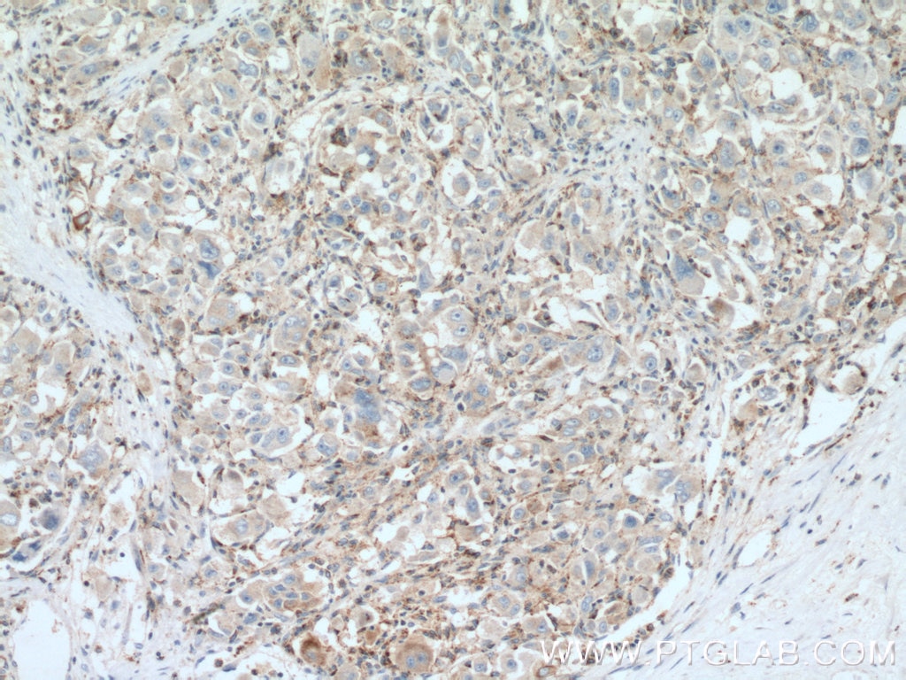 Immunohistochemistry (IHC) staining of human liver cancer tissue using CEP192 Polyclonal antibody (18832-1-AP)