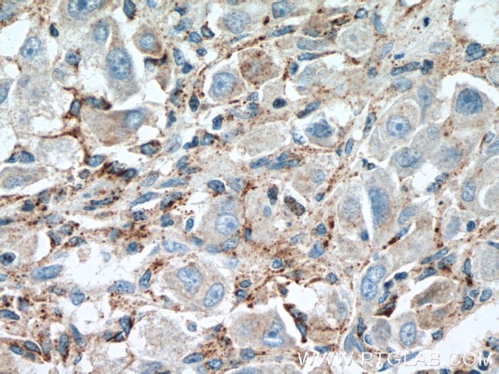 Immunohistochemistry (IHC) staining of human liver cancer tissue using CEP192 Polyclonal antibody (18832-1-AP)
