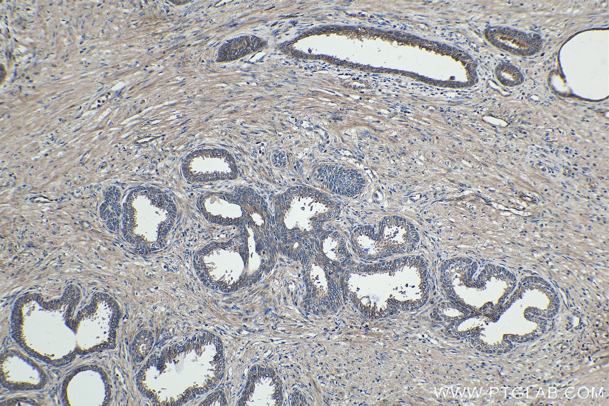 Immunohistochemistry (IHC) staining of human prostate cancer tissue using CEP290 Polyclonal antibody (22490-1-AP)