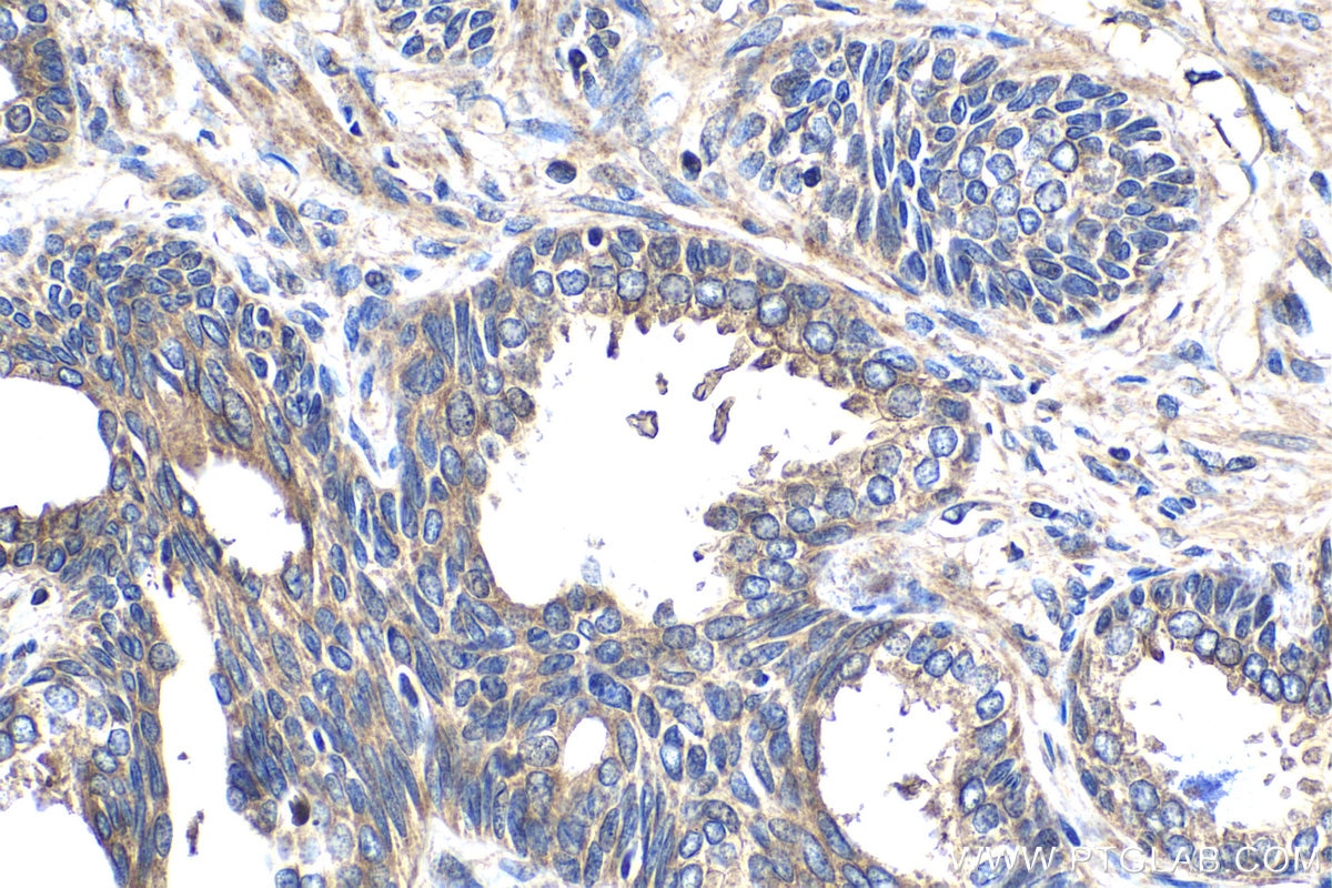 Immunohistochemistry (IHC) staining of human prostate cancer tissue using CEP290 Polyclonal antibody (22490-1-AP)