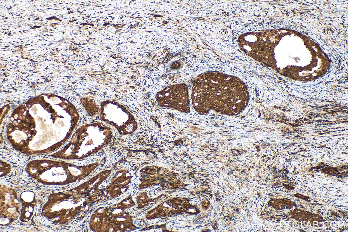 Immunohistochemistry (IHC) staining of human prostate cancer tissue using CEP295 Polyclonal antibody (30446-1-AP)
