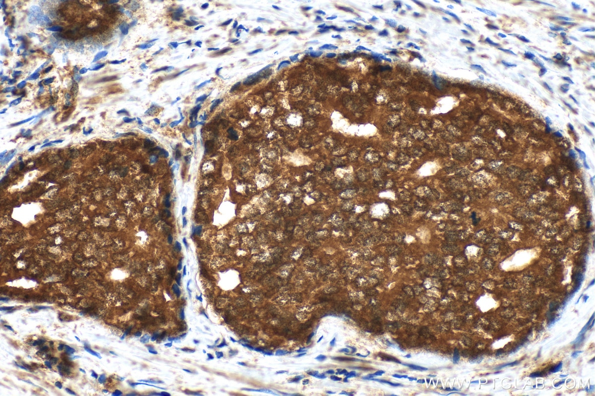 Immunohistochemistry (IHC) staining of human prostate cancer tissue using CEP295 Polyclonal antibody (30446-1-AP)