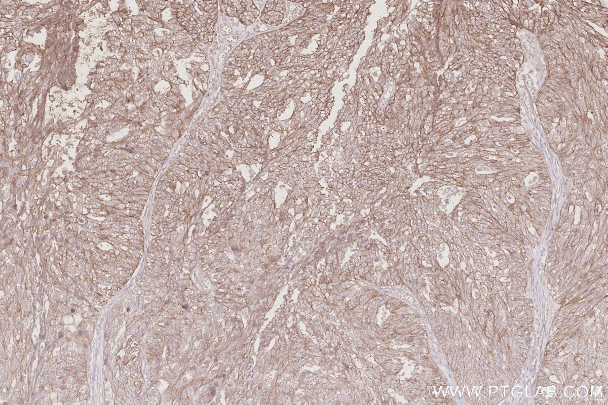 Immunohistochemistry (IHC) staining of human ovary cancer tissue using CEP295 Polyclonal antibody (30446-1-AP)