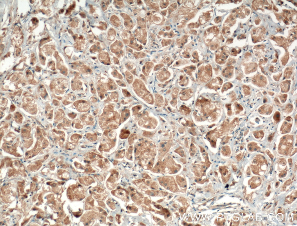 Immunohistochemistry (IHC) staining of human breast cancer tissue using CEP78 Polyclonal antibody (55341-1-AP)