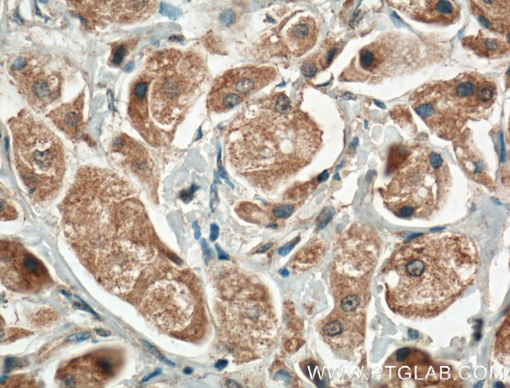 Immunohistochemistry (IHC) staining of human breast cancer tissue using CEP78 Polyclonal antibody (55341-1-AP)