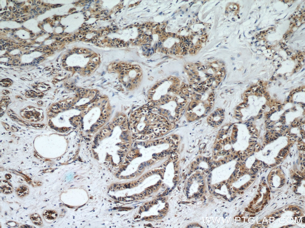 Immunohistochemistry (IHC) staining of human breast cancer tissue using CEP97 Polyclonal antibody (22050-1-AP)