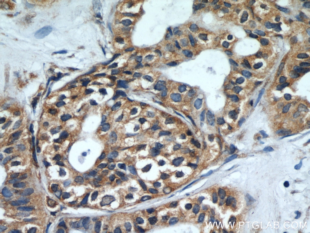 Immunohistochemistry (IHC) staining of human breast cancer tissue using CEP97 Polyclonal antibody (22050-1-AP)