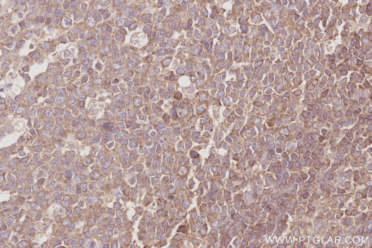 Immunohistochemistry (IHC) staining of human tonsillitis tissue using CEPT1 Polyclonal antibody (20496-1-AP)