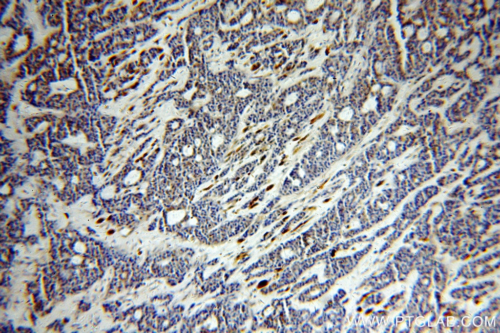 IHC staining of human cervical cancer using 20496-1-AP