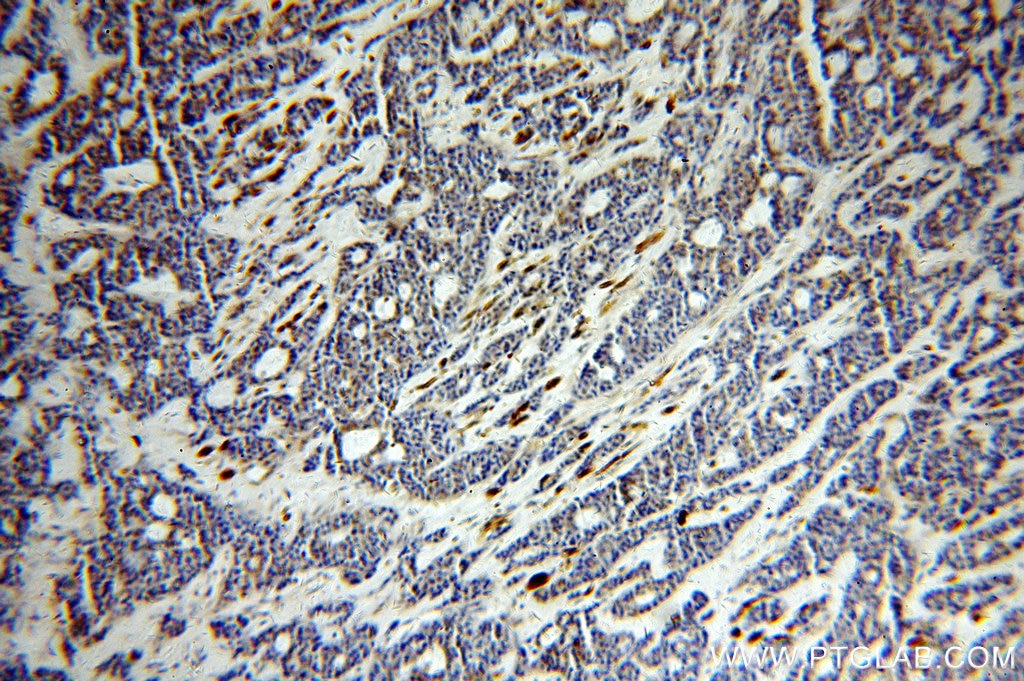 Immunohistochemistry (IHC) staining of human cervical cancer tissue using CEPT1 Polyclonal antibody (20496-1-AP)