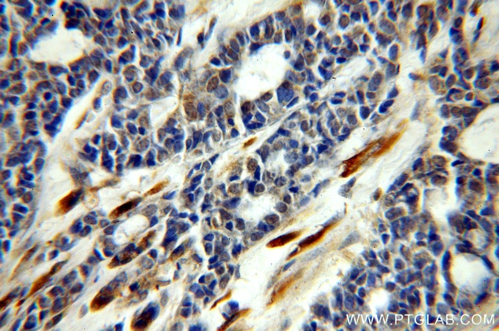 Immunohistochemistry (IHC) staining of human cervical cancer tissue using CEPT1 Polyclonal antibody (20496-1-AP)