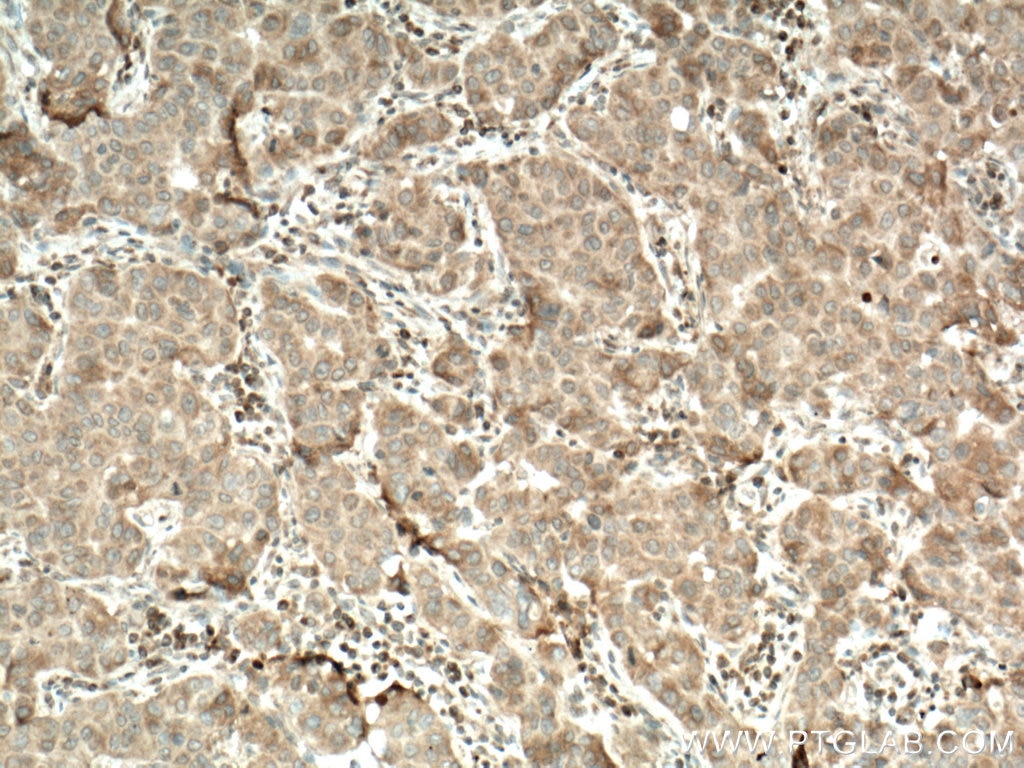 Immunohistochemistry (IHC) staining of human breast cancer tissue using CERK Polyclonal antibody (25731-1-AP)