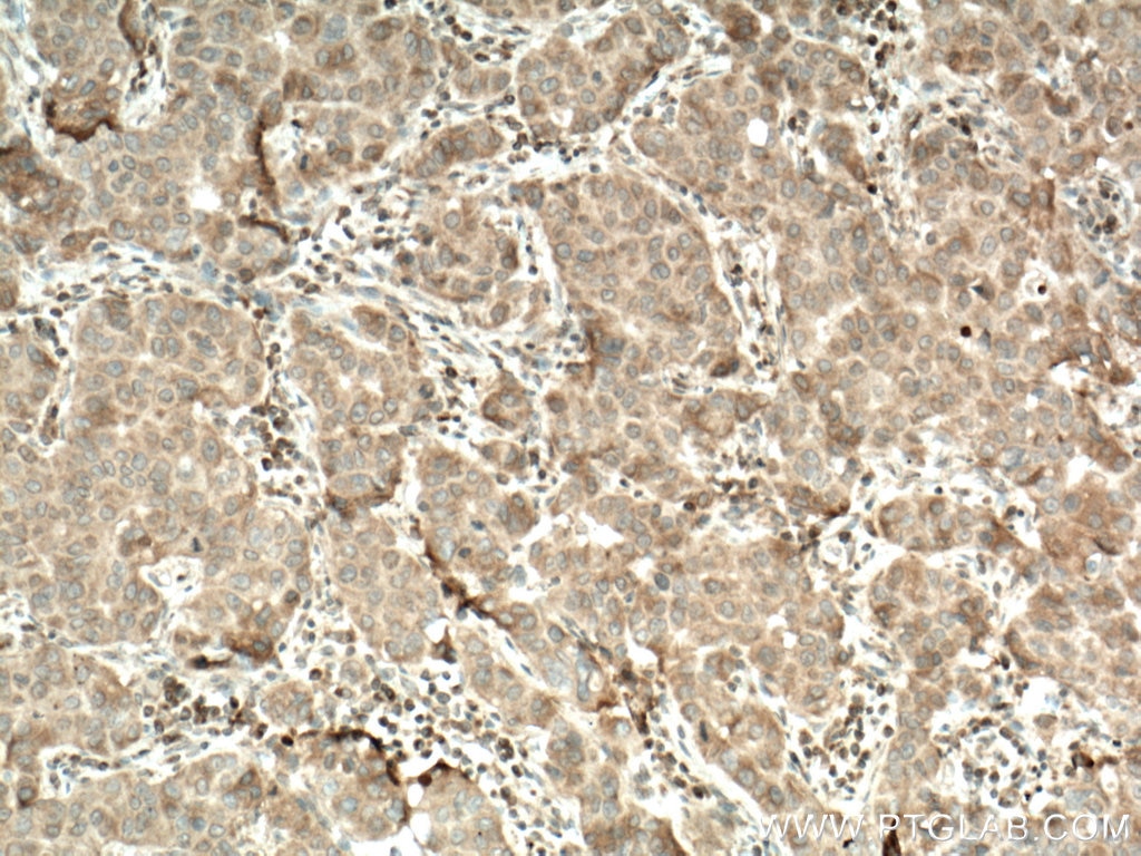 IHC staining of human breast cancer using 25731-1-AP