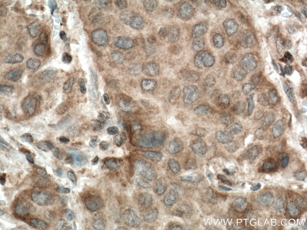 Immunohistochemistry (IHC) staining of human breast cancer tissue using CERK Polyclonal antibody (25731-1-AP)