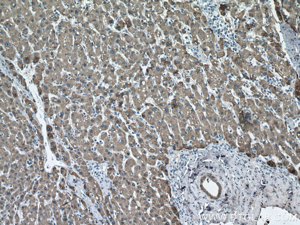 Immunohistochemistry (IHC) staining of human liver cancer tissue using CES1 Polyclonal antibody (16912-1-AP)
