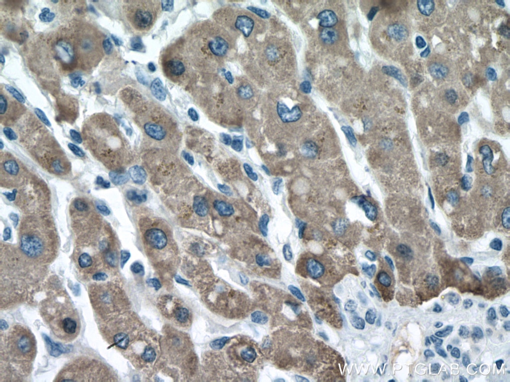 Immunohistochemistry (IHC) staining of human liver cancer tissue using CES1 Polyclonal antibody (16912-1-AP)