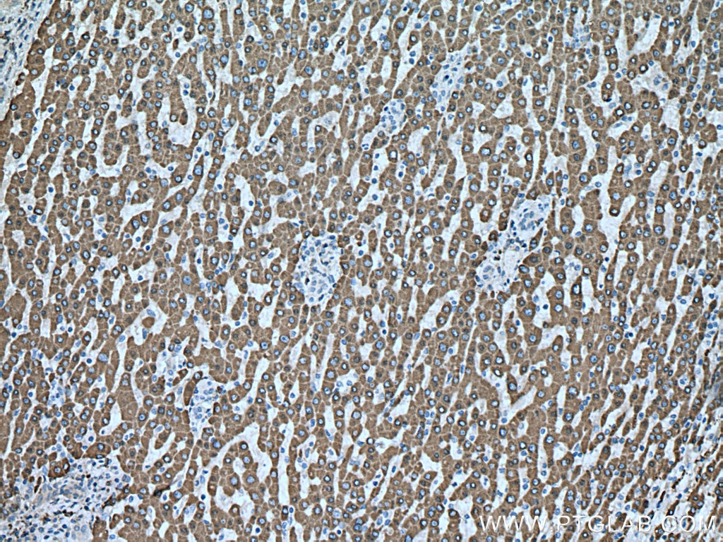 Immunohistochemistry (IHC) staining of human liver cancer tissue using CES1 Polyclonal antibody (16912-1-AP)