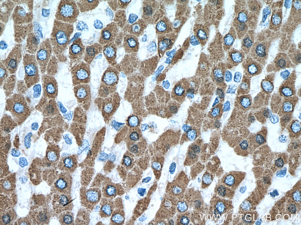 IHC staining of human liver cancer using 16912-1-AP