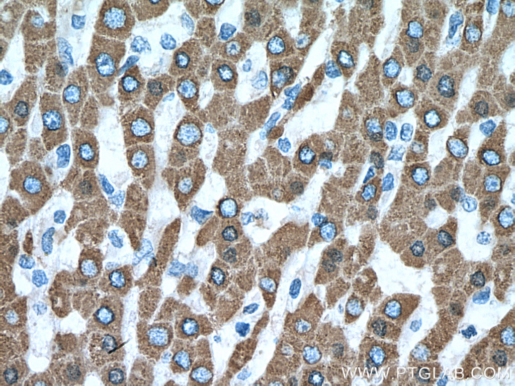 Immunohistochemistry (IHC) staining of human liver cancer tissue using CES1 Polyclonal antibody (16912-1-AP)