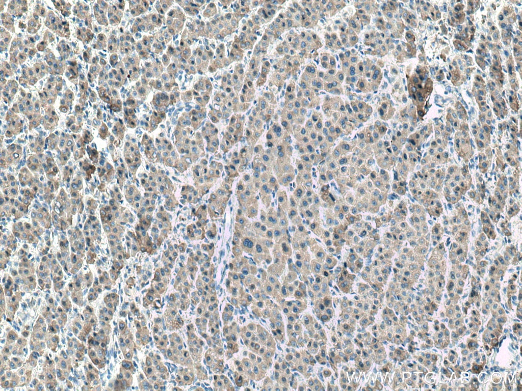 Immunohistochemistry (IHC) staining of human liver cancer tissue using CES1 Monoclonal antibody (67079-1-Ig)