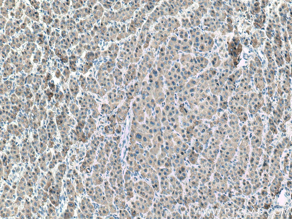 IHC staining of human liver cancer using 67079-1-Ig