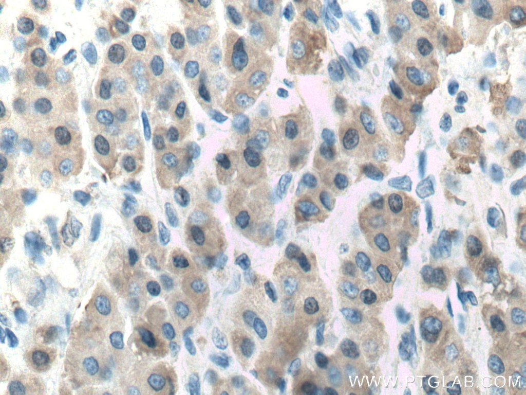 Immunohistochemistry (IHC) staining of human liver cancer tissue using CES1 Monoclonal antibody (67079-1-Ig)