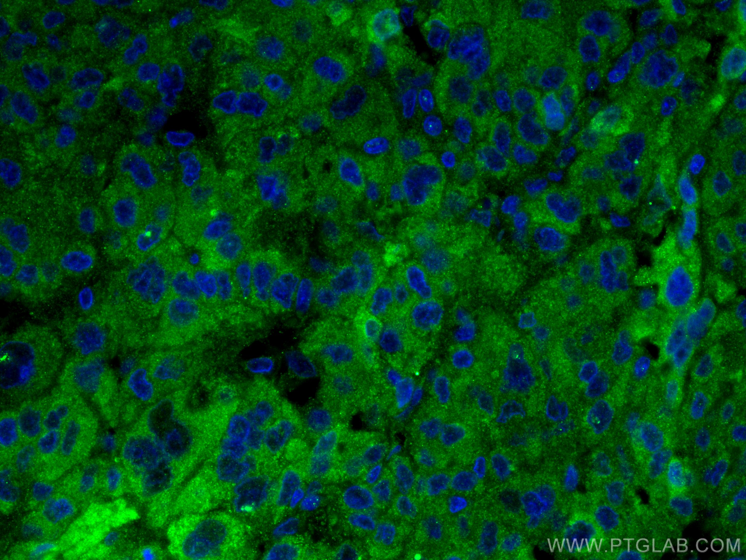 Immunofluorescence (IF) / fluorescent staining of human liver cancer tissue using Complement factor H Polyclonal antibody (12748-1-AP)