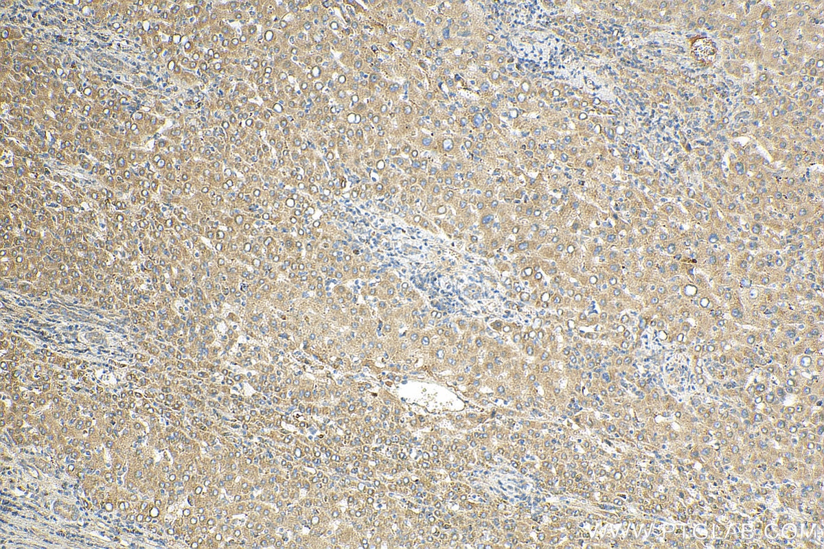 Immunohistochemistry (IHC) staining of human liver cancer tissue using Complement factor H Polyclonal antibody (12748-1-AP)
