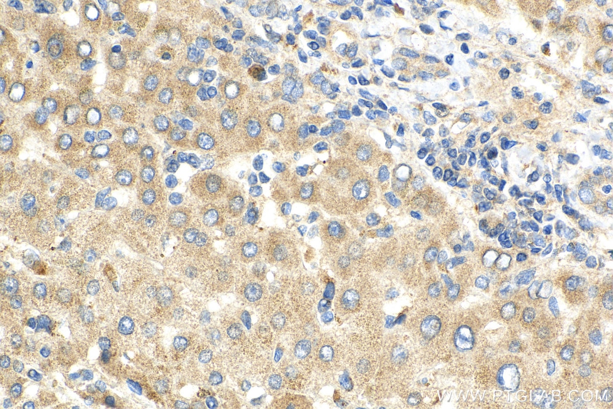 Immunohistochemistry (IHC) staining of human liver cancer tissue using Complement factor H Polyclonal antibody (12748-1-AP)