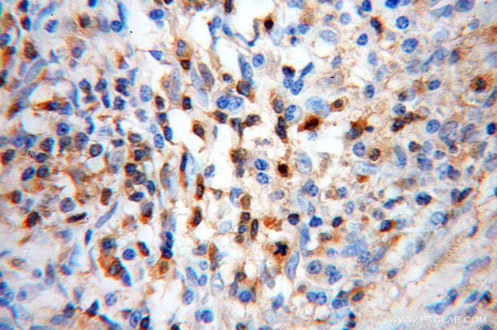 Immunohistochemistry (IHC) staining of human cervical cancer tissue using Cofilin Polyclonal antibody (10960-1-AP)