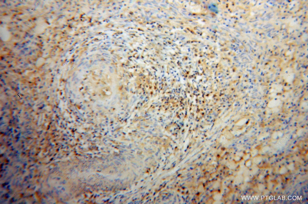 Immunohistochemistry (IHC) staining of human cervical cancer tissue using Cofilin Polyclonal antibody (10960-1-AP)