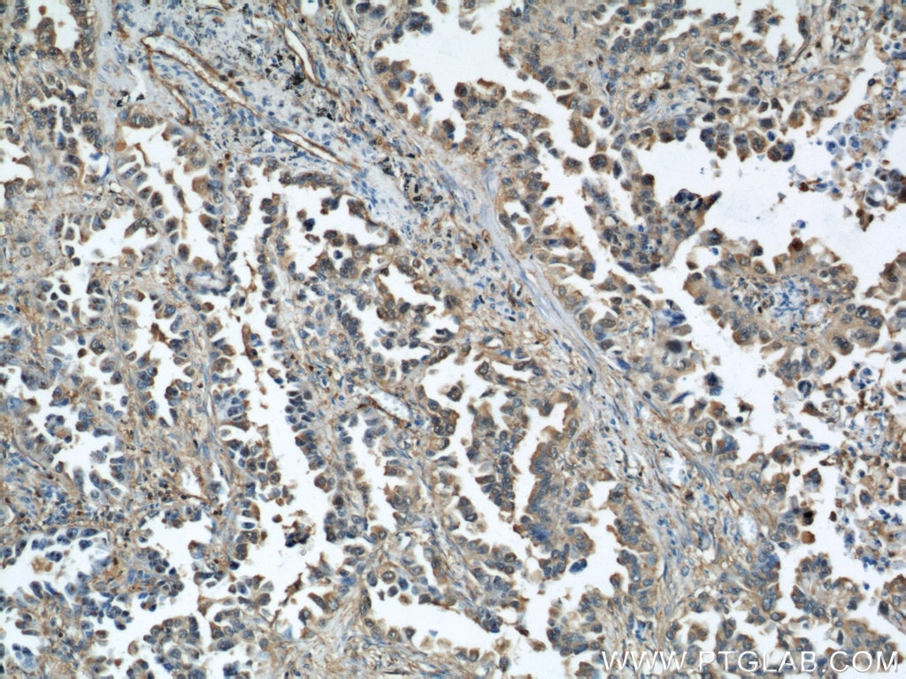 Immunohistochemistry (IHC) staining of human lung cancer tissue using Cofilin Polyclonal antibody (10960-1-AP)