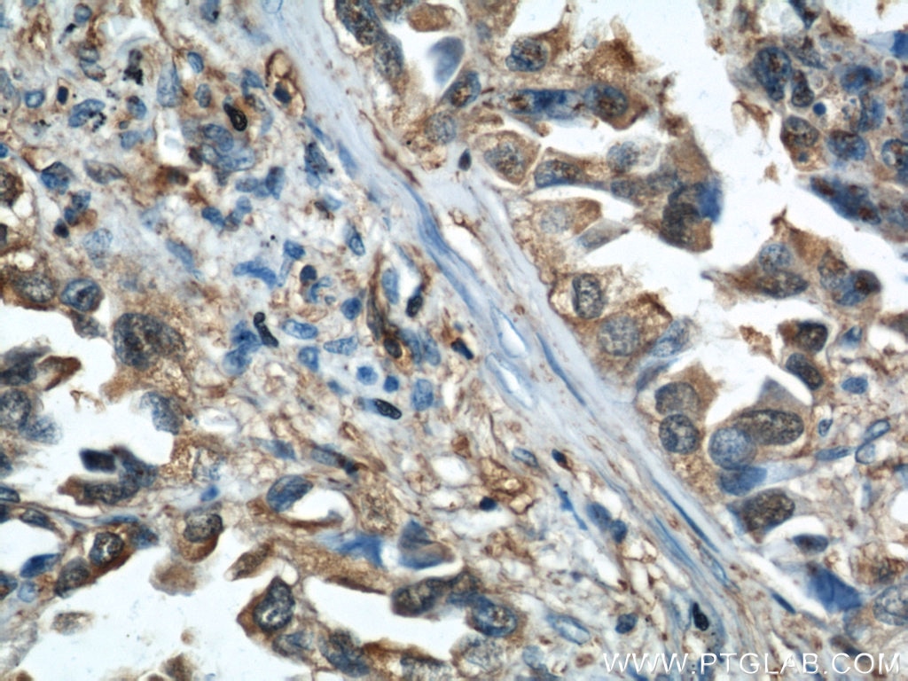 Immunohistochemistry (IHC) staining of human lung cancer tissue using Cofilin Polyclonal antibody (10960-1-AP)