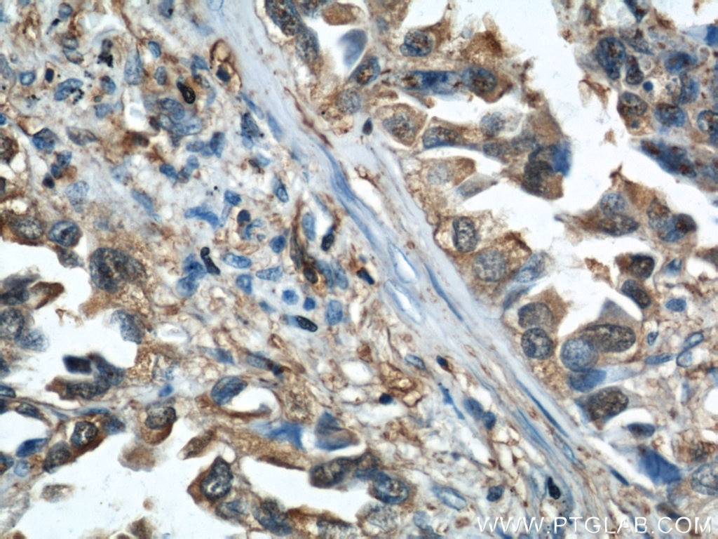 IHC staining of human lung cancer using 10960-1-AP