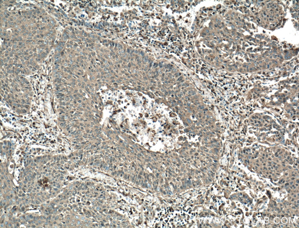 IHC staining of human lung cancer using 66057-1-Ig