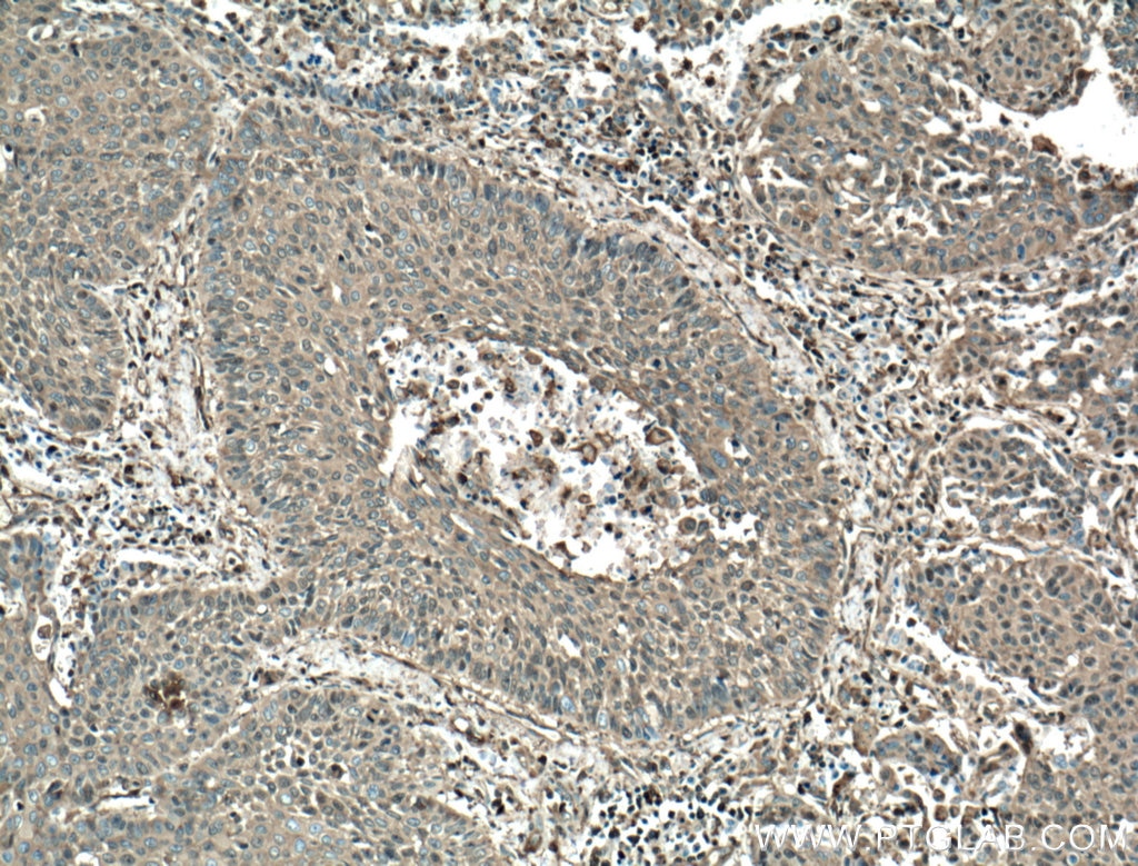 Immunohistochemistry (IHC) staining of human lung cancer tissue using Cofilin Monoclonal antibody (66057-1-Ig)