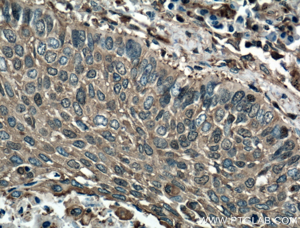Immunohistochemistry (IHC) staining of human lung cancer tissue using Cofilin Monoclonal antibody (66057-1-Ig)