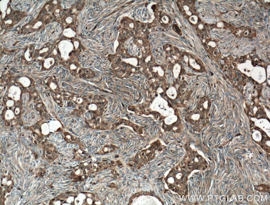Immunohistochemistry (IHC) staining of human ovary tumor tissue using Cofilin Monoclonal antibody (66057-1-Ig)