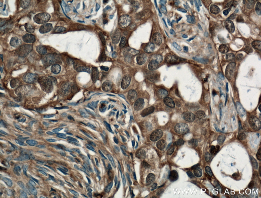Immunohistochemistry (IHC) staining of human ovary tumor tissue using Cofilin Monoclonal antibody (66057-1-Ig)